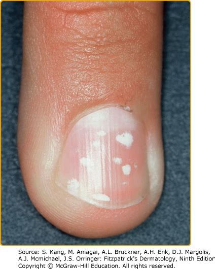 leukonychia definition|leukonychia punctata.